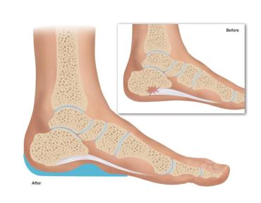 Heel Spurs: An Overview of Symptoms, Causes, and Treatments - Custom  Orthotics Blog - Upstep