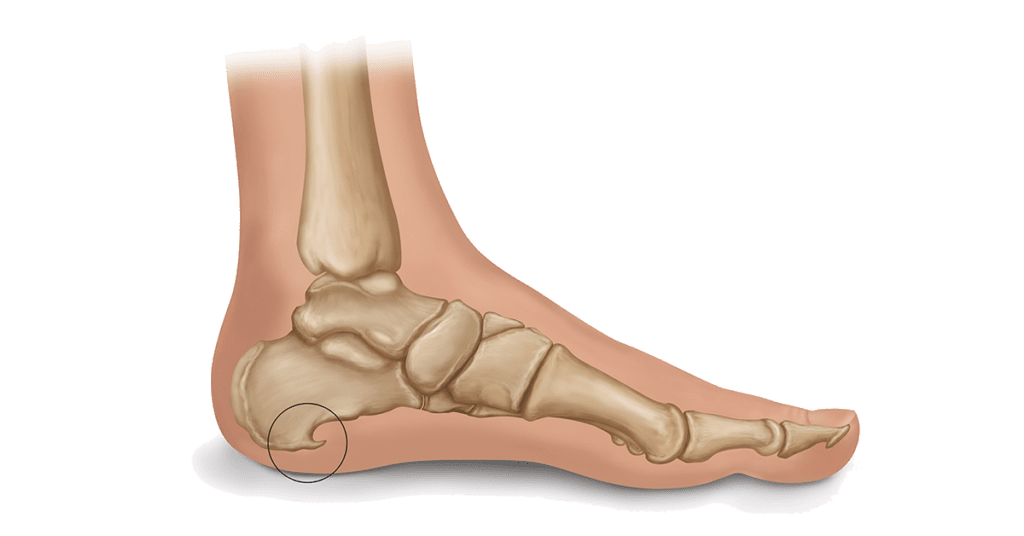 Heel Bursitis Treatment | OSMO Patch US