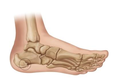 The Consequences of Leaving Plantar Fasciitis Untreated - Plantar
