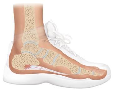 Plantar Fasciitis - Top Symptoms, Causes, and Treatments for Heel Pain