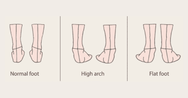 Arch Height: How To Tell If You Have High Arches Or Flat Feet - Tread Labs