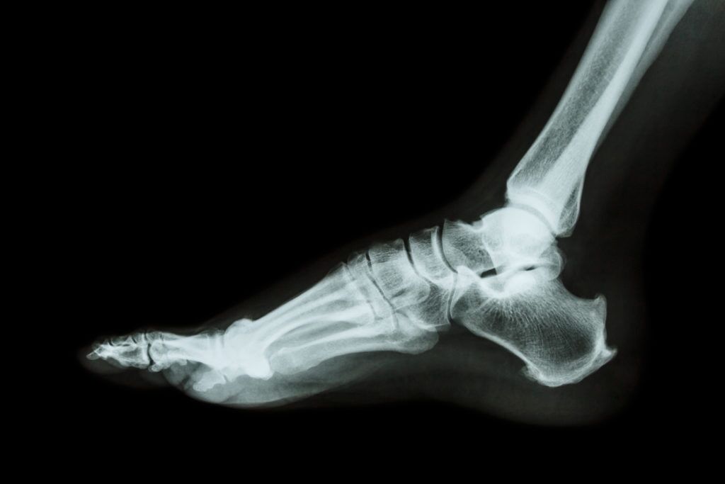 X-ray Right Heel LAT View | Test Price in Delhi | Ganesh Diagnostic