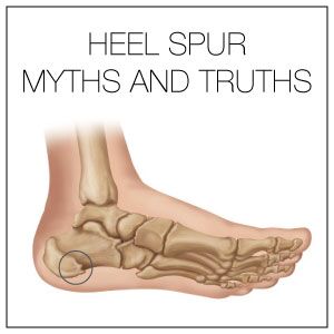 7 Heel Spur Myths and Facts
